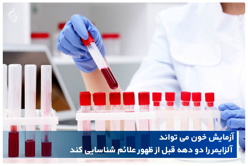 تشخیص آلزایمر و میزان پیشرفت آن با آزمایش خون