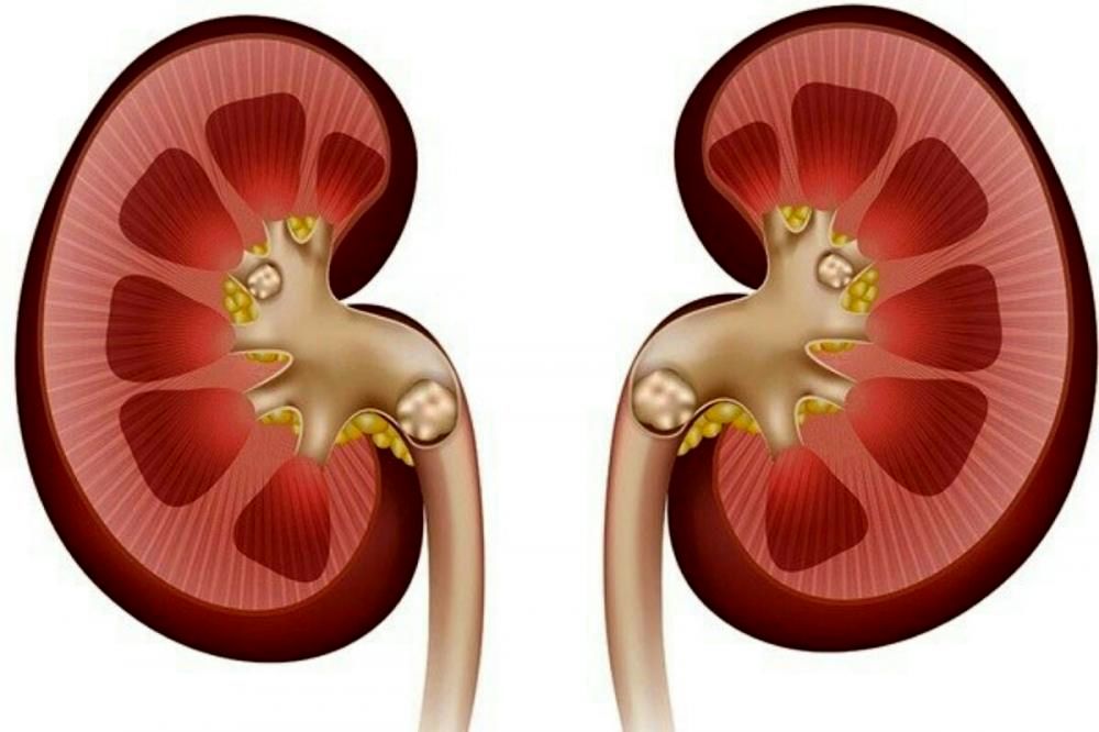 علائم، درمان و باورهای غلط درباره سنگ کلیه