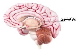 چگونه علائم پارکینسون را  شناسایی کنیم؟